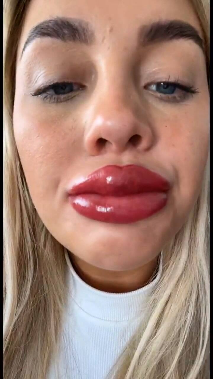 Se tatuó los labios y tras hacerse el tratamiento se dio cuenta de algo