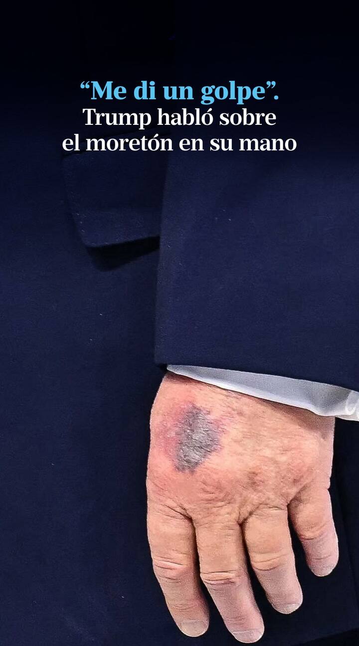Trump dio explicaciones sobre su moretón en la mano