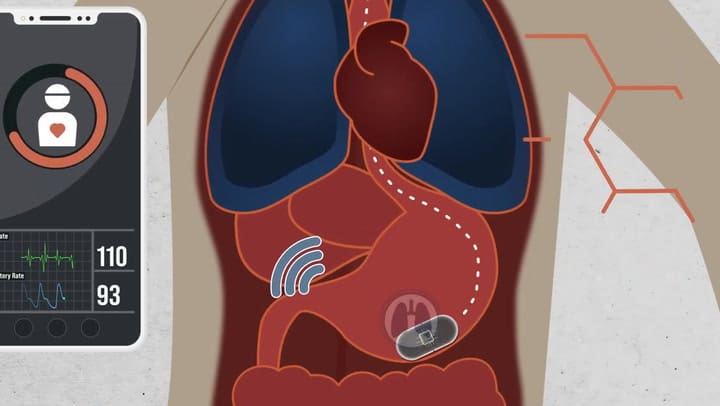La cápsula que monitorea la apnea creada por el MIT