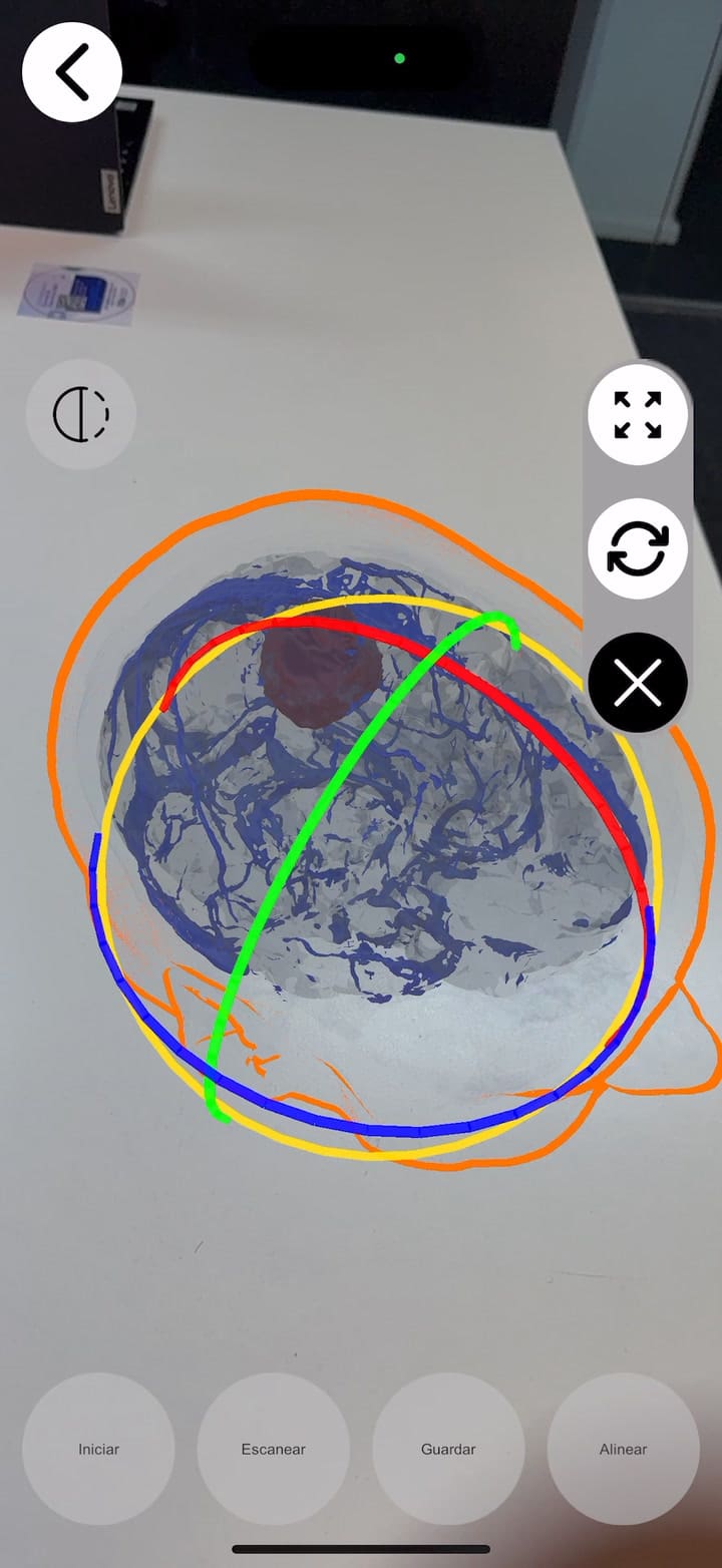 Una vista de cómo funciona Visionay, la plataforma de realidad aumentada para cirugías