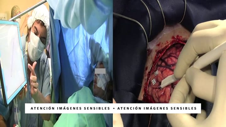 Operación de cerebro