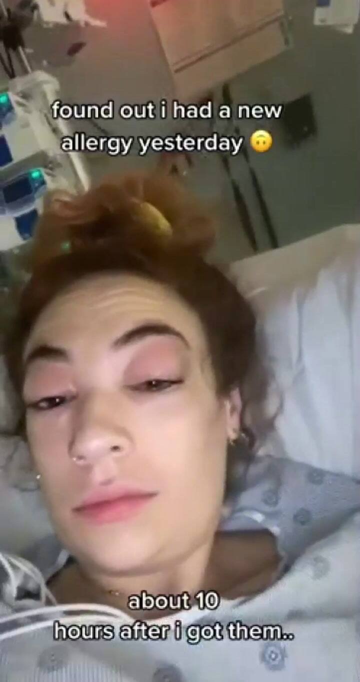La increíble reacción alergica de una tiktoker