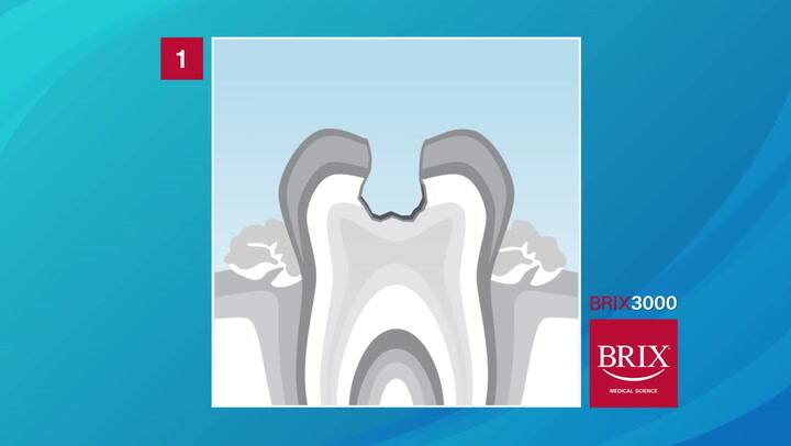 Así funciona el gel anti-caries