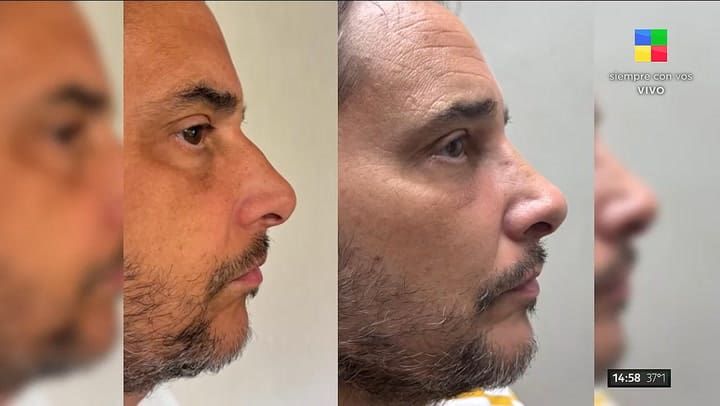 Rodrigo Lussich conto los detalles de su cirugia