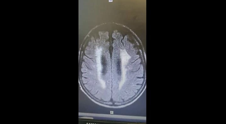 Las “manchas” blancas en esta resonancia de cerebro son “infartos silenciosos”