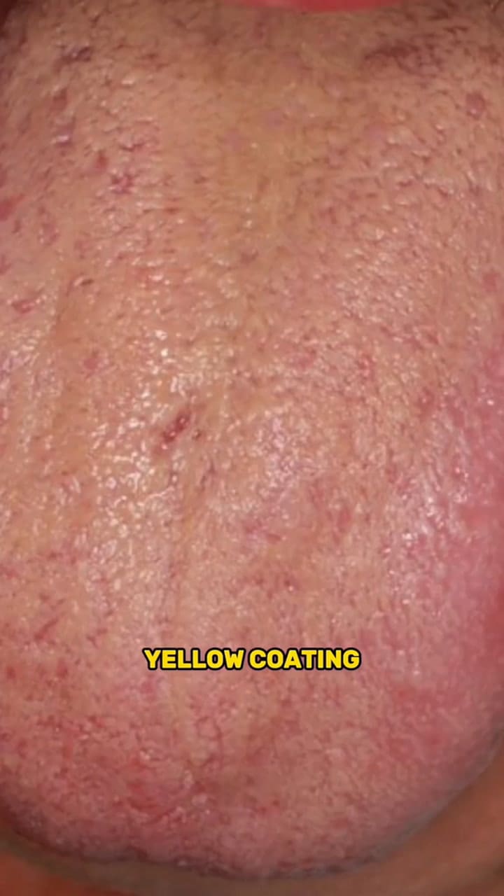 El doctor que explica por qué no deberías tomar café si tenés una marca en la boca