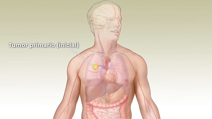 Metástasis: cómo se disemina el cáncer