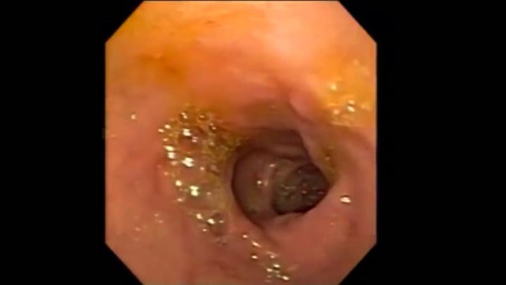 Qué es una endoscopia y cómo funciona