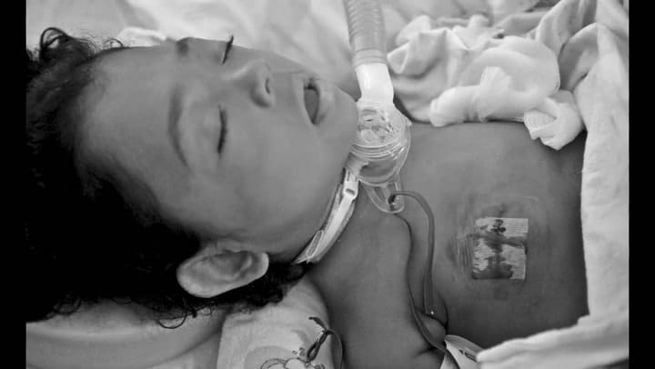 Jenally, la niña que nació sin huesos