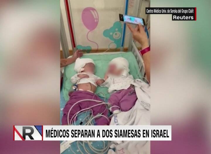 Separan a dos gemelas unidas por la cabeza tras una operación de 12 horas en Israel