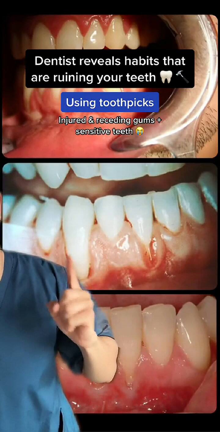 El tiktoker compartió tres hábitos que muchas personas realizan pero podrían dañar sus dientes