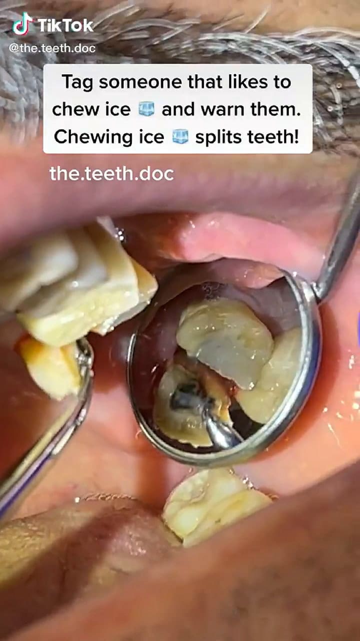 Un dentista revela por qué nunca hay que masticar hielo