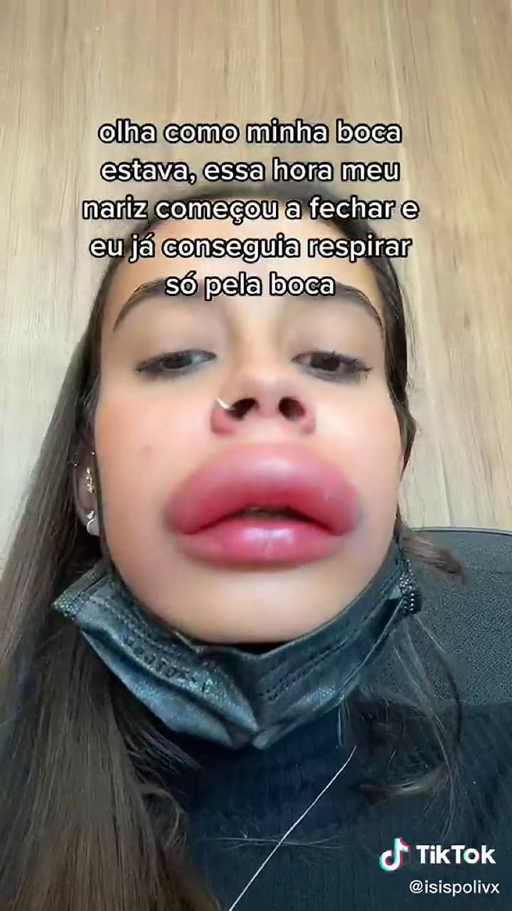 El devastador aspecto de una influencer tras someterse a un tratamiento estético