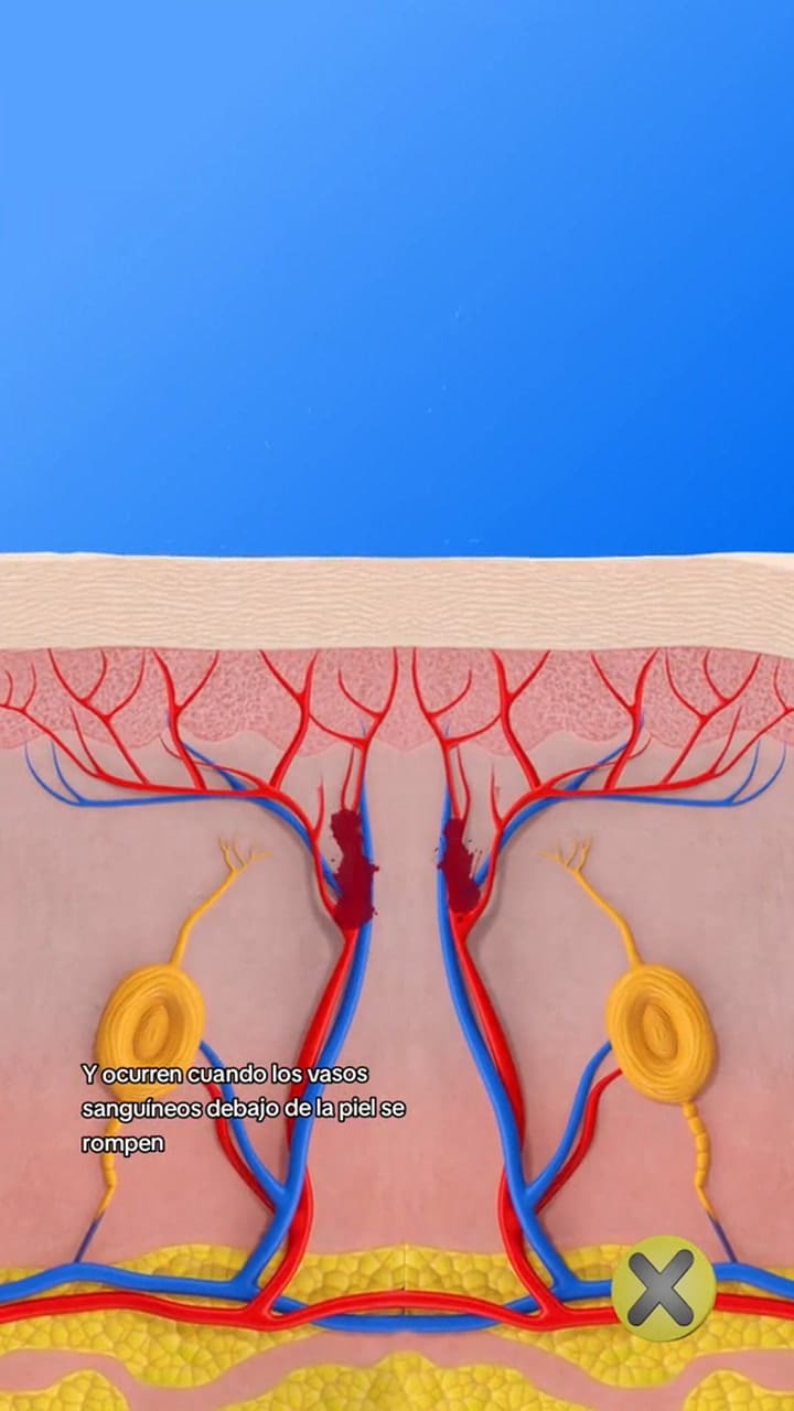 La explicación técnica de cómo salen los hematomas