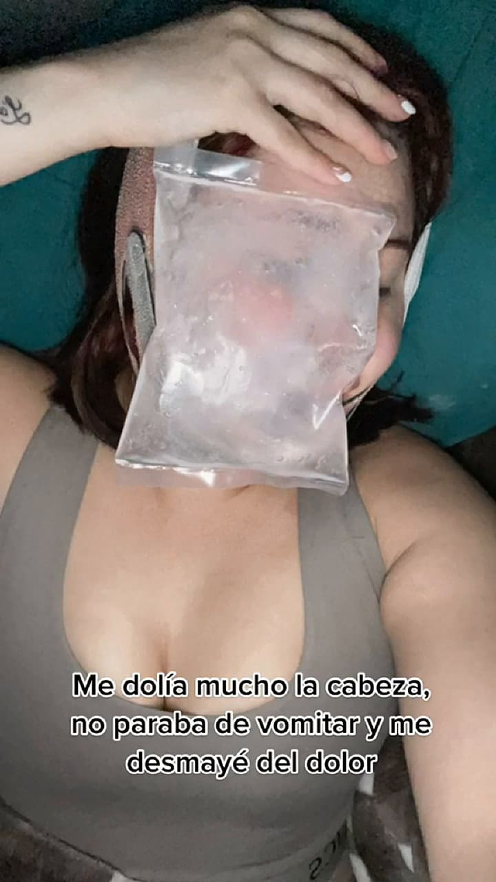 Se realizó una bichectomía y obtuvo un inesperado resultado: “La mejilla se iba a estallar”