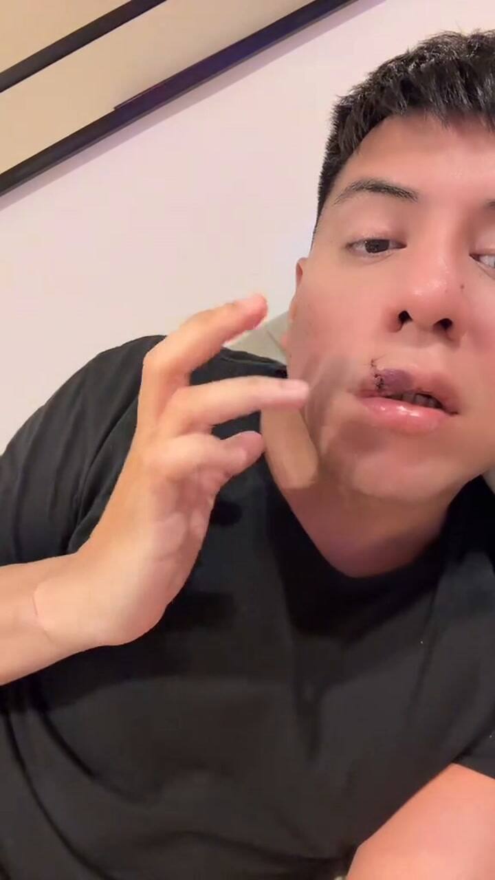 Mariano De La Canal contó que lo mordió un perro