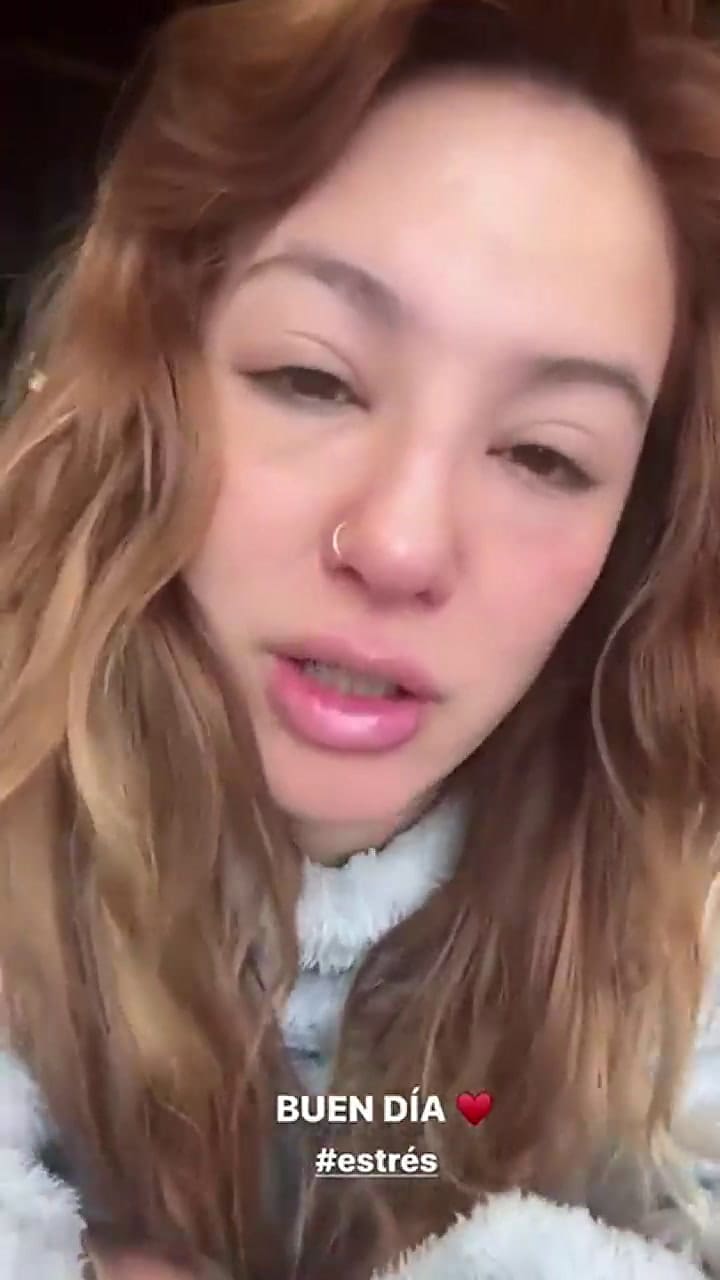 Flor Vigna mostró su cara hinchada en las redes