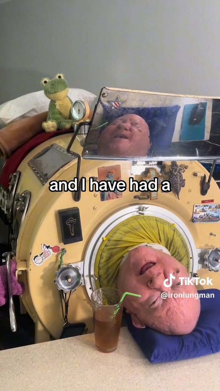 La historia del hombre que fue trasplantado con un pulmón de acero y murió 70 años después