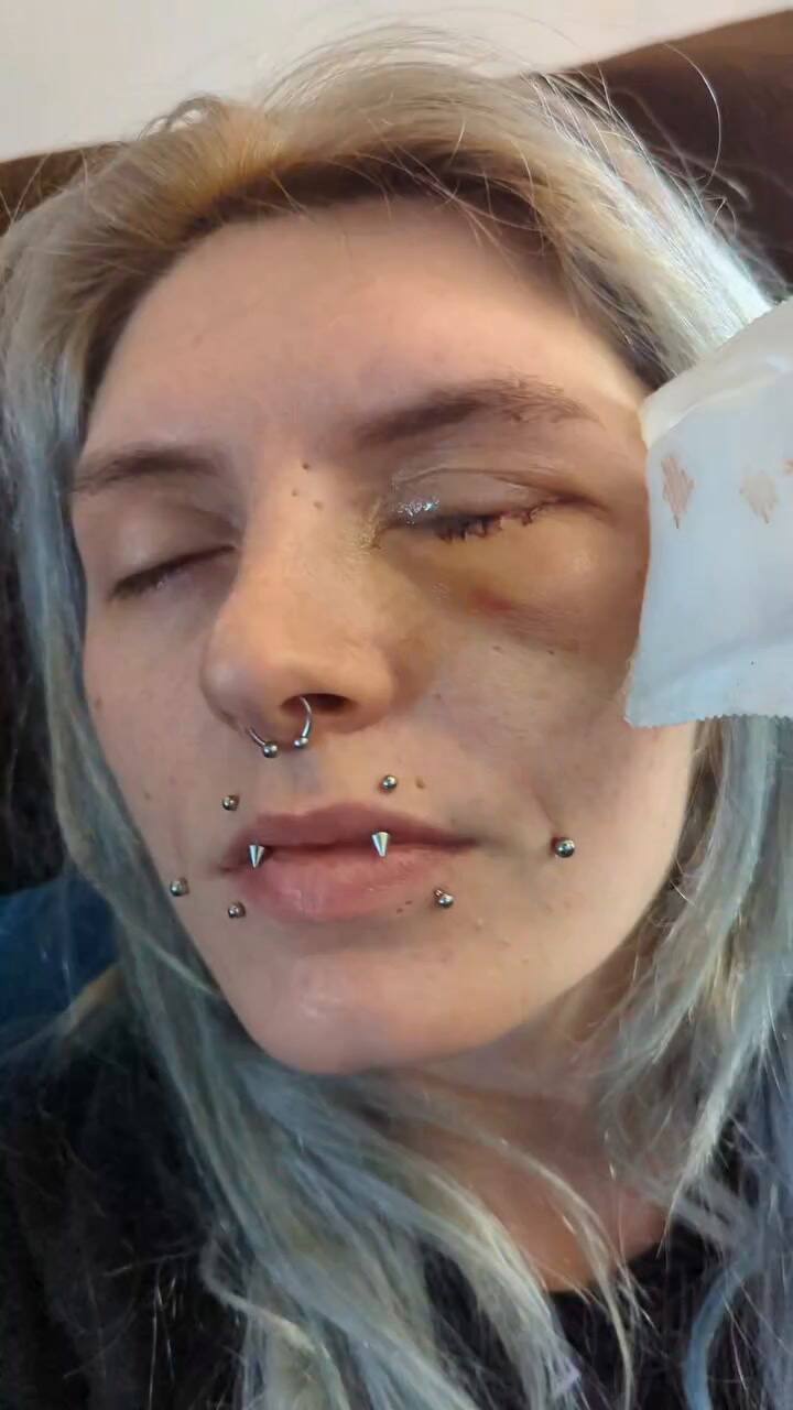 Es una madre de Minnesota de 28 años, pensó que tenía un vaso sanguíneo reventado, pero perdió su ojo