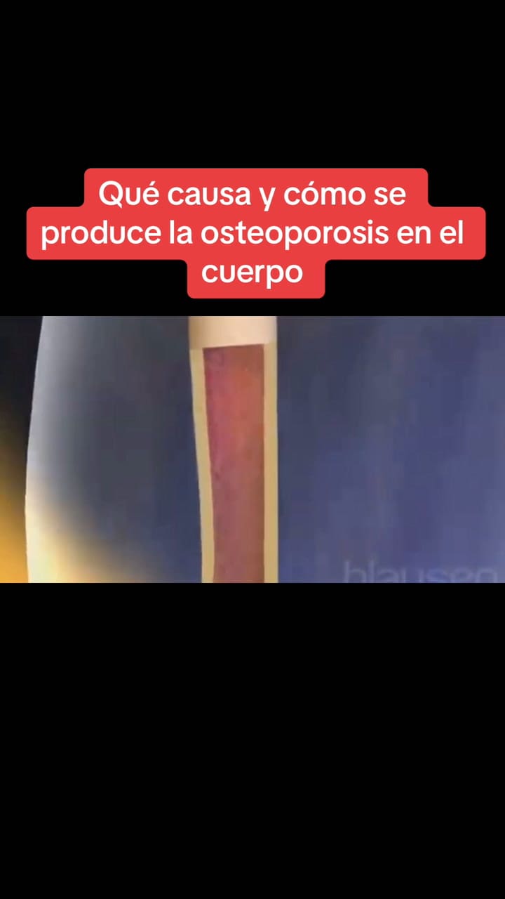 Que lo causa y cómo se produce la osteoporosis