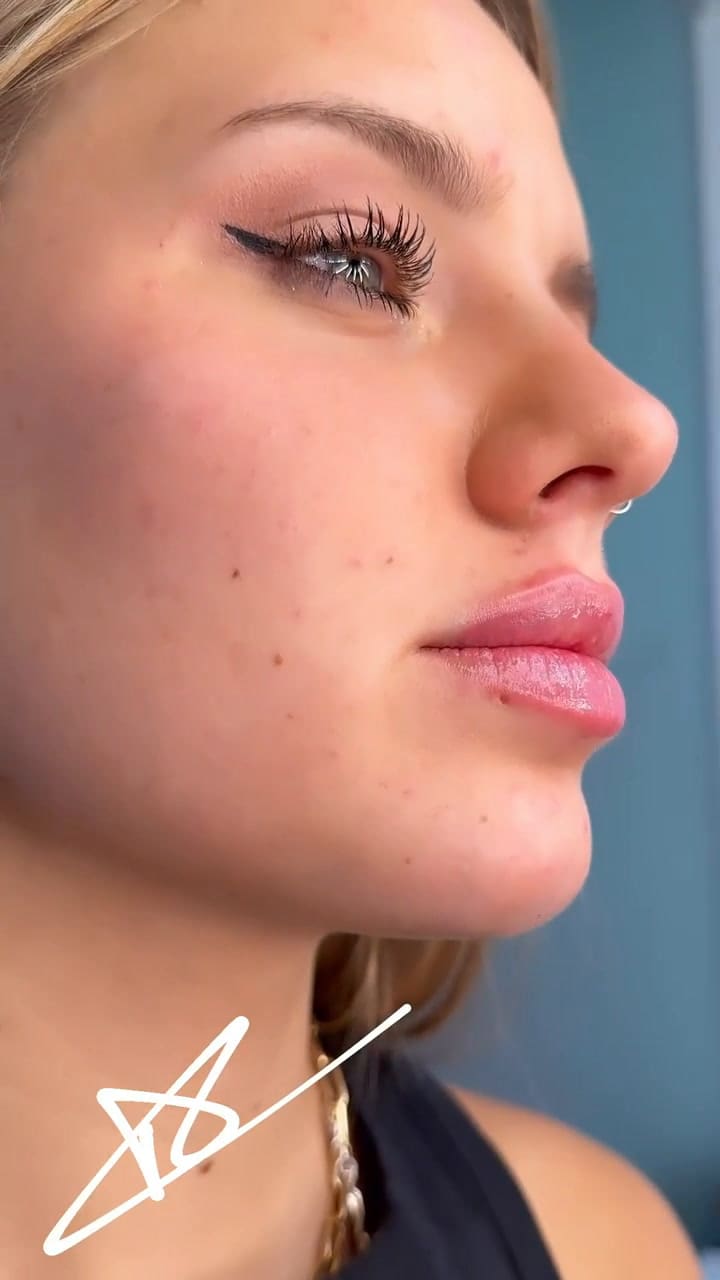 El retoque estético de Coti de Gran Hermano