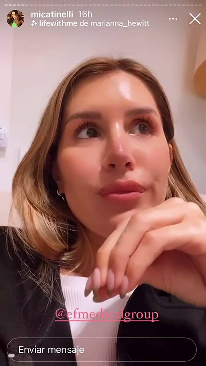 Mica Tinelli mostró el procedimiento que se hizo para sacarse los tatuajes de su adolescencia