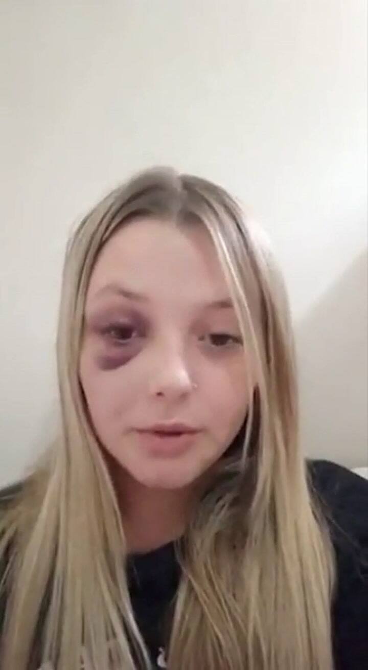 Agustina cuenta cómo terminó con golpes en el cuerpo y un ojo morado tras la agresión de un hombre