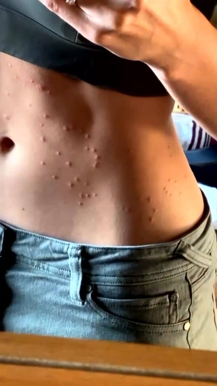 Así se ve estar enfermo de malaria