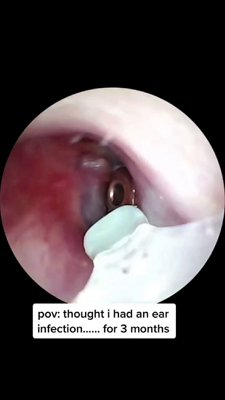 Pensó que tenía una infección de oído pero quedó atónita al descubrir la causa