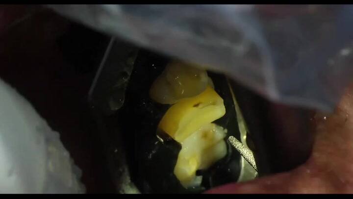 El robot dentista de Perceptive en acción