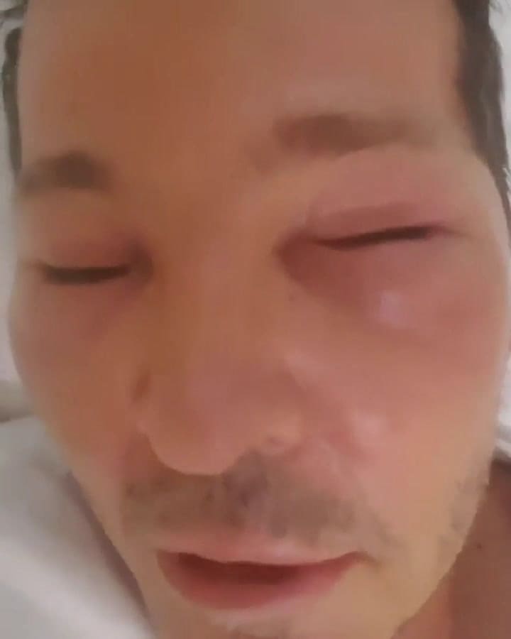 Guido Süller fue internado por una inflamación en el rostro - Fuente: Instagram