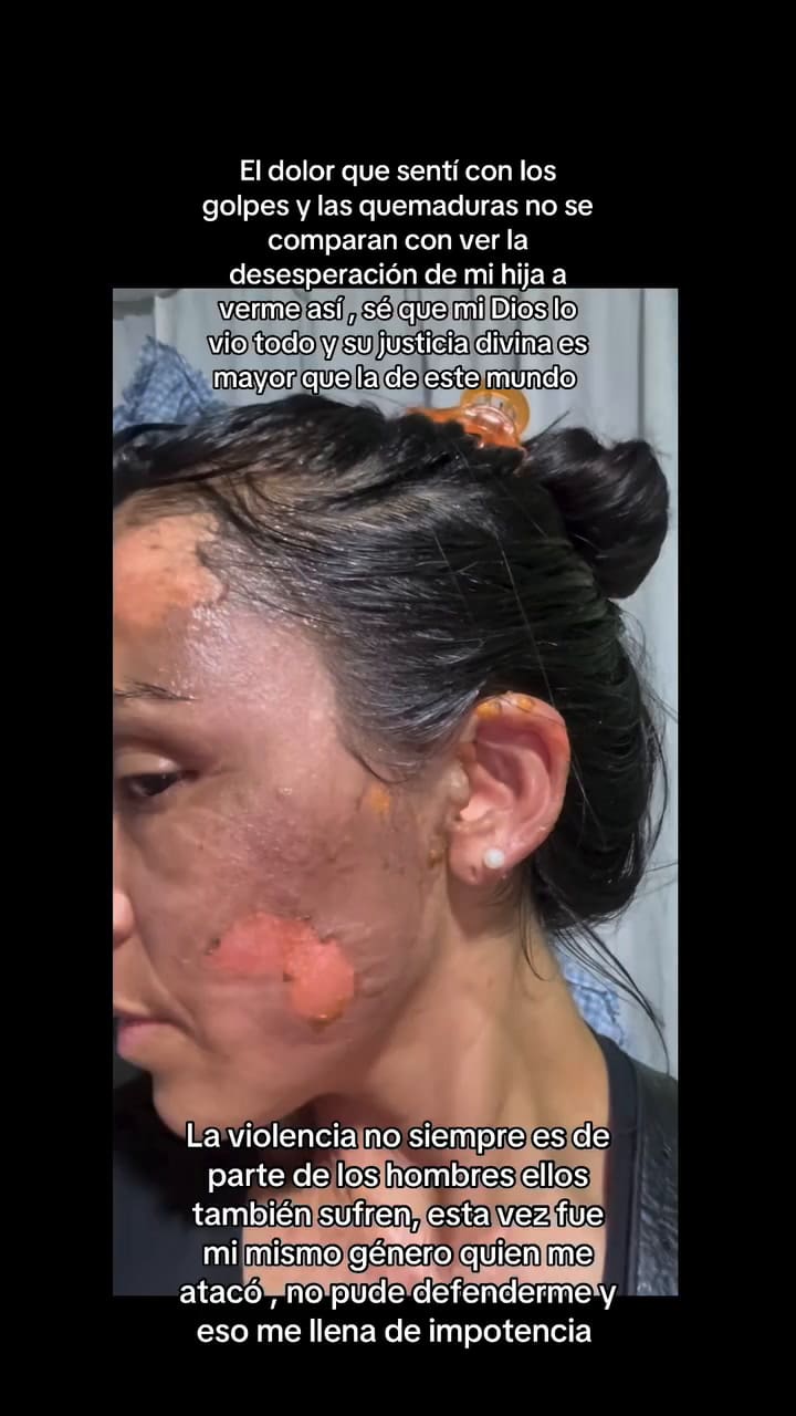 María Teresa Miranda mostró sus heridas en su cuenta de Instagram.