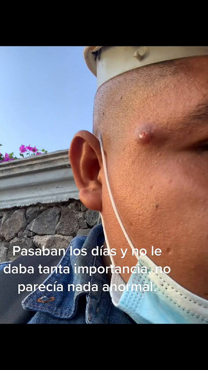 El usuario de TikTok Alonso Castillo relató su experiencia con un 'grano'