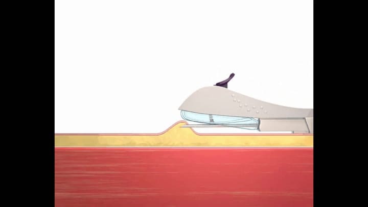 Así se aplica el anticonceptivo subdérmico