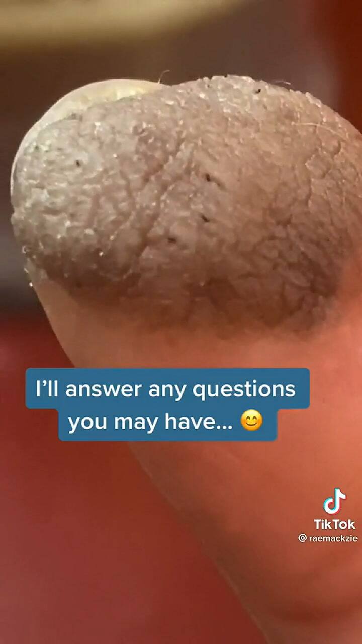 Comenzó a crecerle vello púbico en un dedo y su caso se hizo viral