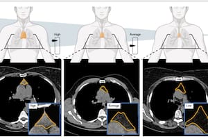 El pequeño órgano que se daba por terminado y que ahora aparece ligado al riesgo de muerte y enfermedad