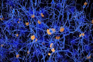 Los otros efectos que genera en el cuerpo  la amiloidosis y preocupan a los médicos