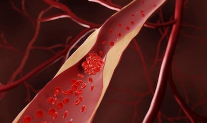 Ilustración de un coágulo de sangre formándose en una arteria estrechada.