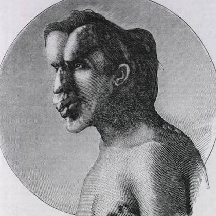 Ilustración del rostro de Joseph Merrick, y de su cabeza, cuya circunferencia medía 92 centímetros según los análisis realizados por el cirujano Frederick Treves