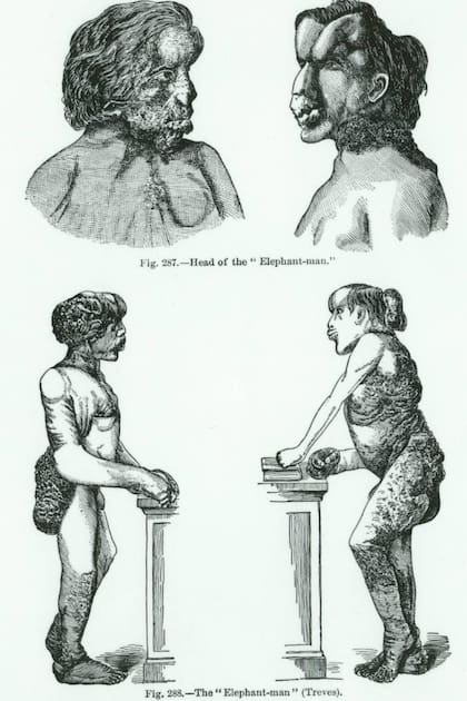 Ilustraciones de ambos perfiles de Joseph Merrick que fueron realizadas para Frederick Treves