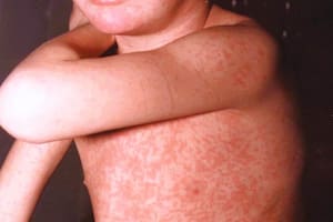 Detectaron un nuevo caso de sarampión en Entre Ríos y se reactivó la alerta a nivel nacional