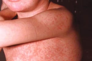 sarampión par apapel - Clone