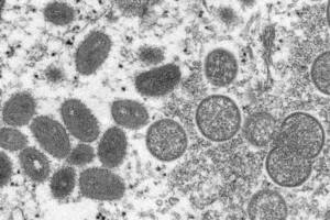 Francia y Alemania confirman sus primeros casos de viruela del mono y la OMS convoca a expertos