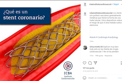 Imagen de un stent coronario para desobstruir arterias