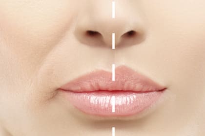 Imagen que muestra el surco nosogeniano