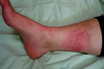 La erisipela es una infección de la piel causada por una bacteria conocida como Streptococcus pyogenes.