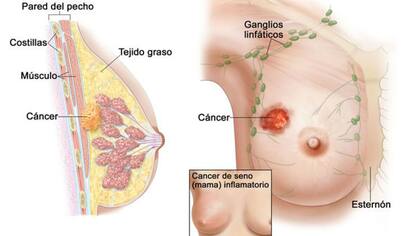 Infografía de la aparición de un cáncer mamario