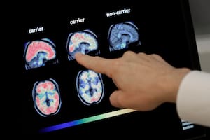Un análisis de sangre alerta de los primeros síntomas diez años antes de tener en Alzheimer