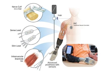 iSens es un sistema que combina una prótesis, un emisor Bluetooth y una serie de electrodos para devolverle el sentido del tacto a una persona que sufrió la amputación de un brazo