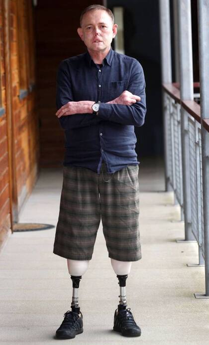 Jaco Nel perdió sus dos piernas y todos los dedos de su mano derecha a causa de la sepsis provocada por la bacteria de su perro Harvey